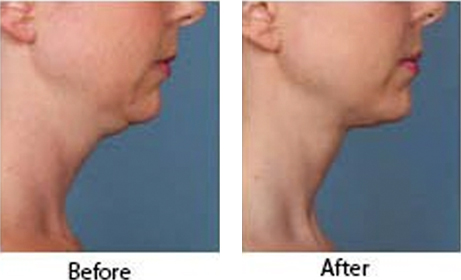 Kybella Before & After