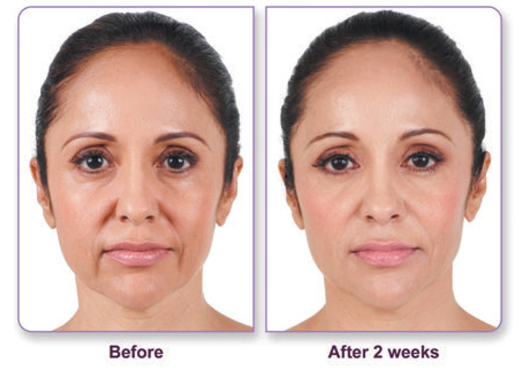 Juvederm® before & after
