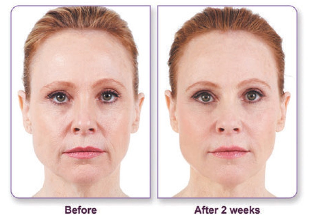 Dermal Fillers Results Cupertino