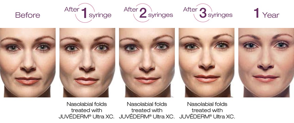 Juvederm® before & after