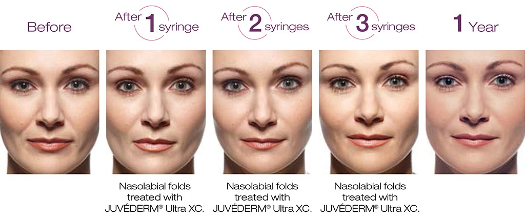 Juvederm® Procedure Cupertino